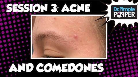 Session Three: Acne and Comedones