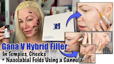 Gana V (Hybrid Filler) in Temples, Cheeks, Nasolabial Folds w/ Cannula | Code Jessica10 Saves Money!