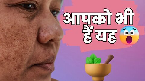 The Top 5 Causes of Pigmentation and How to Prevent Them | Hindi