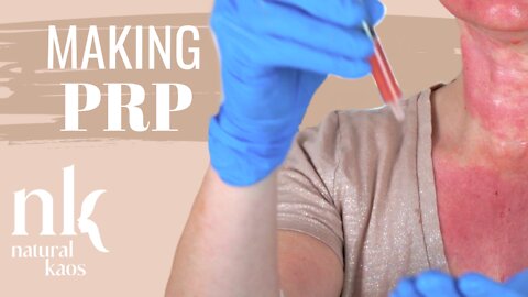 How to Make PRP at Home, DIY PRP and Microneedling