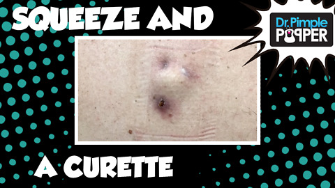 Inflamed Cyst: The Final Squeeze & Curette