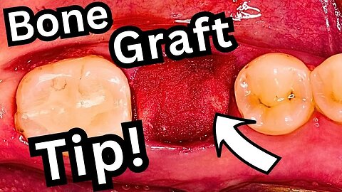 #1 Tip for Simple Bone Graft Suturing [Socket Preservation]