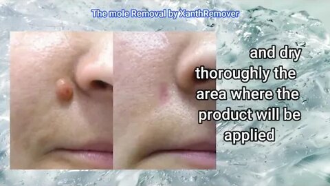 Mole Removal, Benign mole, Easy & Safe removal solution at home using 70% Glycolic Acid Peel