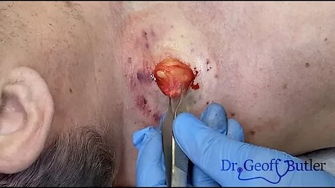 Lipoma removal along the base/side of the neck/shoulder