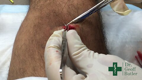 Removal of a Granuloma on the Right Leg