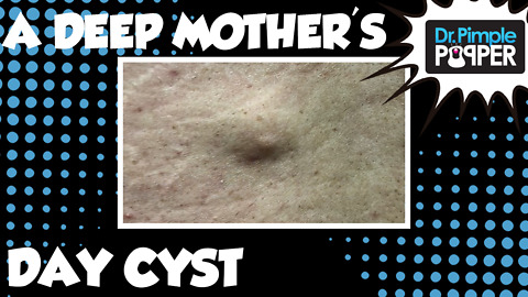 A Cyst for Mother's Day
