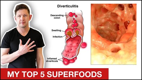 My 5 BEST Foods For Diverticulitis || Diverticulitis Diet Plan