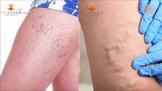 Your Healthy Family: Treating spider and varicose veins