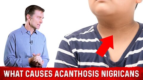 What Causes Acanthosis Nigricans (Darkened Skin Folds)? – Dr. Berg