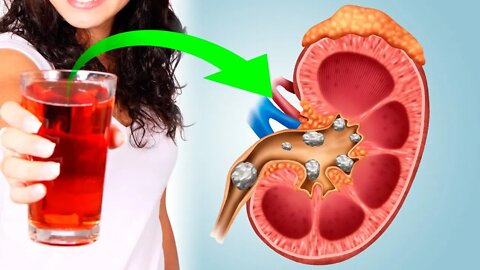 How to Cleanse & Detox Your Kidneys Naturally