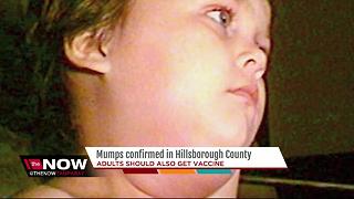 Mumps confirmed in Hillsborough Co.