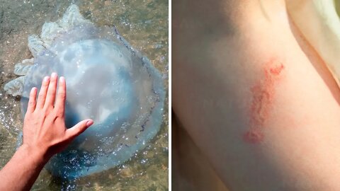How To Treat Jellyfish Stings Naturally