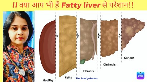 How to Treat Fatty liver disease|alcohlic and non alcohlic fatty liver