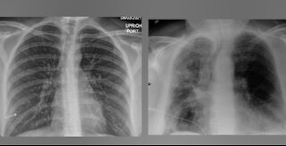 COVID lung X-rays of San Diego patients show 'remarkable' impact of vaccines