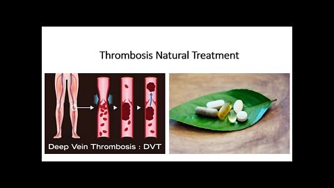 Thrombosis Natural Treatment