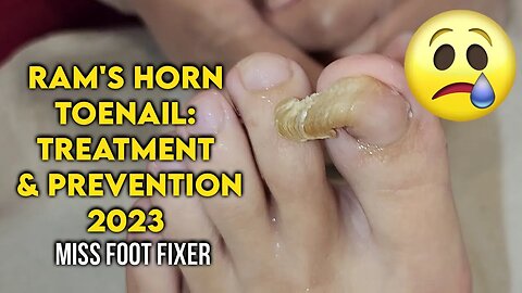 Ram's Horn Toenail: Causes, Treatment, and Prevention | Tips By Foot Specialist Miss foot fixer