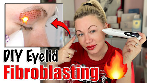 DIY Eyelid Fibroblasting with my Mole Pen | Code Jessica10 Saves you Money at Approved Vendors