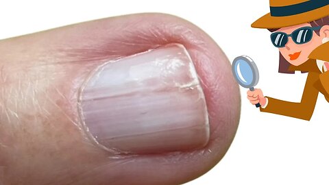 Splitting nail problems [Anna's Nail Advice]