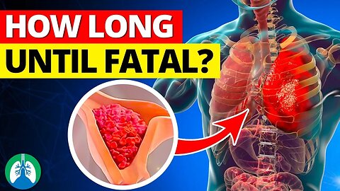 How Long for a Pulmonary Embolism to Become Fatal? ☠️