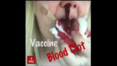 Vaccine Injured: Young Woman's Nose Bleed Turns Into a Nasty Blood Clot