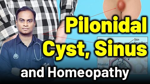 Pilonidal Cyst, Sinus and Homeopathy Treatment . | Dr. Bharadwaz | Homeopathy, Medicine & Surgery