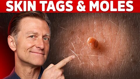 Use Iodine for Skin Tags and Warts – Dr.Berg on Skin Tag Removal