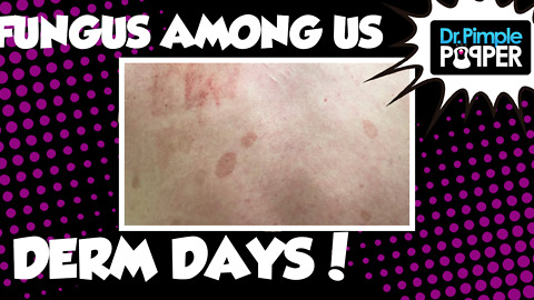 Derm Days: A Fungus Among Us | Diagnosing Tinea Versicolor