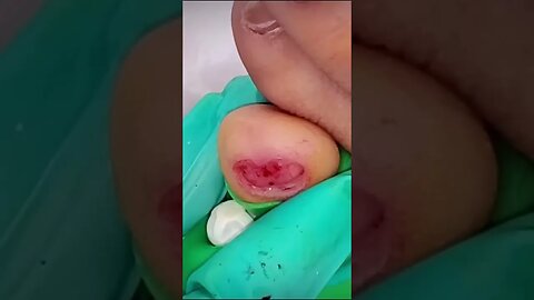 LITTLE PINKY TOE PERMANENT FUNGAL NAIL REMOVAL 2023 BY FAMOUS PODIATRIST MISS FOOT FIXER