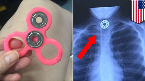 Fidget spinner dangers: Texas girl chokes on fidget spinner she accidentally swallowed - TomoNews