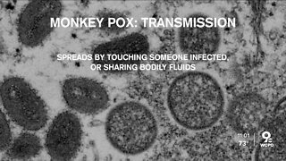 2 cases of monkeypox reported in Cincinnati, health department says
