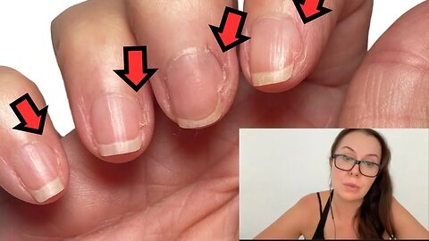 Nail plate wider than the nail bed? (clip from my personal nail assessment)
