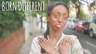 The Girl Whose Skin Peels Off | BORN DIFFERENT