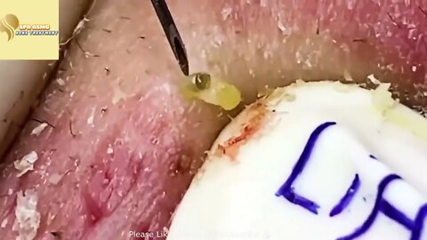 🦯🤢 Remoção PERFEITA de cravos enormes. Big blackhead extraction, perfect!! 🥵