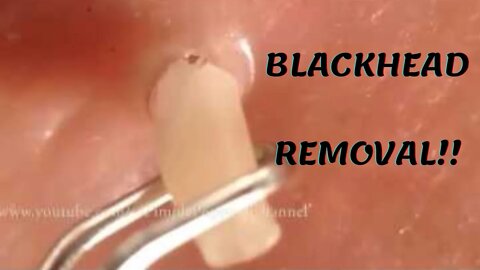 Huge blackhead removal/extraction !! Whitehead pimple cravo acne