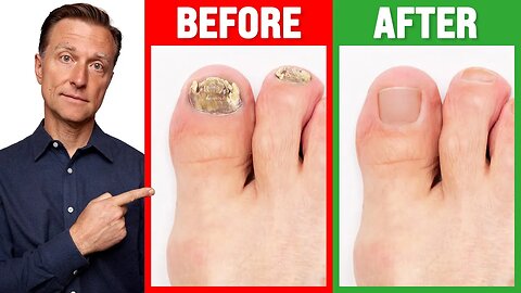 The REAL Cause of Toenail Fungus is ...