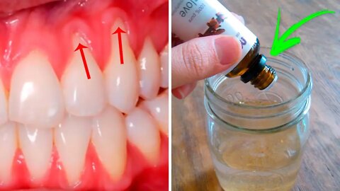 3 Easy Ways to Heal Receding Gums Naturally