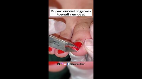 2022 Super curved ingrown toenail removal by foot specialist miss foot fixer