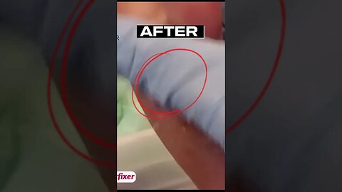 15 Year Old Corn Removal | Miss Foot Fixer | Marion Yau