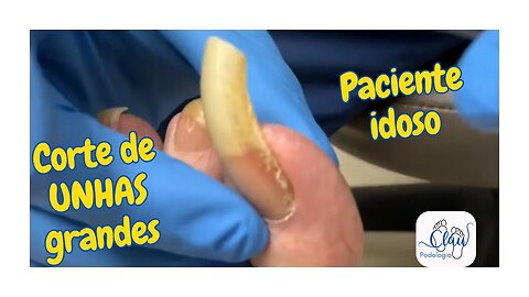 CORTE de UNHAS grandes, paciente IDOSO #unhas #pes #dor #podologia #cortes #idosos