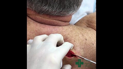 Removal of lipoma on the upper back