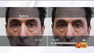 Rapidly Fix Puffy Eyes in Minutes