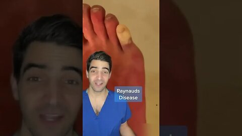 Raynauds disease
