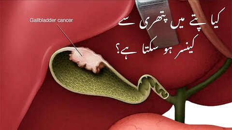 Gallbladder cancer Urdu video