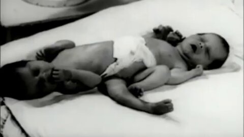 What does this study of conjoined twins say about infectious disease, importance of antibodies?