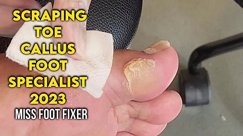 Scraping Toe Callus: Effective Techniques for Callus Removal By Foot Specialist Miss Foot Fixer