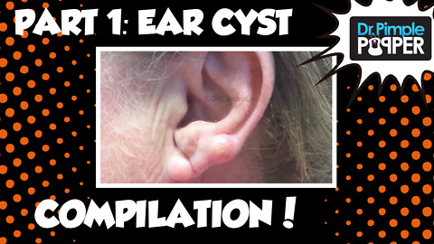 Ear Ya GO! 👂🏽Ear Cyst Compilation Part I