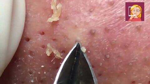 Removal / extraction of blackheads and pimples. Satisfying videos to relax!