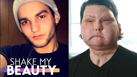 My Face & Double-Hand Transplant Was The World's First | SHAKE MY BEAUTY