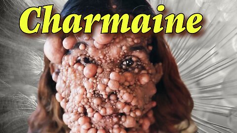 Charmaine's Unbelievable Battle with Neurofibromatosis | TLC Take My Tumor