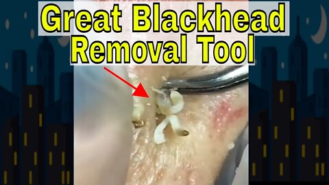 Great blackhead removal tool to squeeze and pull 😋🪱 #blackheadremoval #blackhead #blackheads